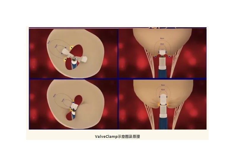 Satisfactory results! | ValveClamp® completes 10 cases of functional mitral regurgitation exploratory clinical study